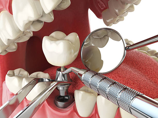 Best Emergency Treatment for Dental Infections or Abscesses in Commack, NY